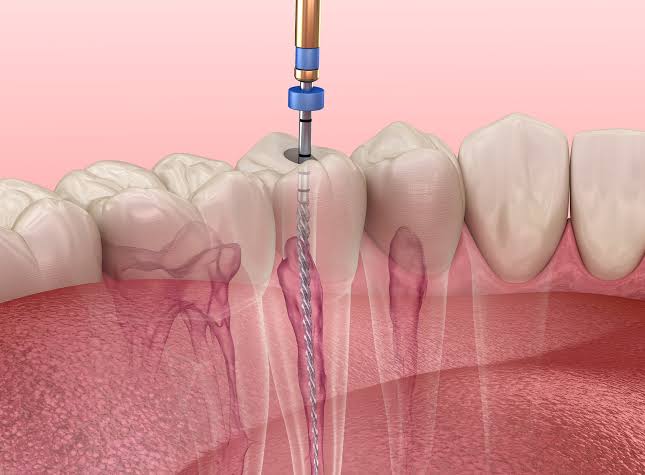 Root Canal Treatment