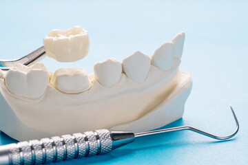 Crowns and Veneers