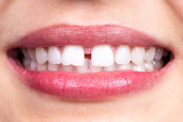 Diastema Closure with Composite Veneer