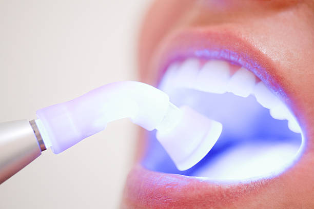 Laser Teeth Whitening
