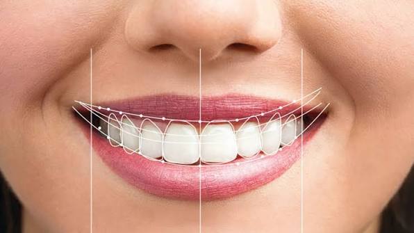 Smile Makeover