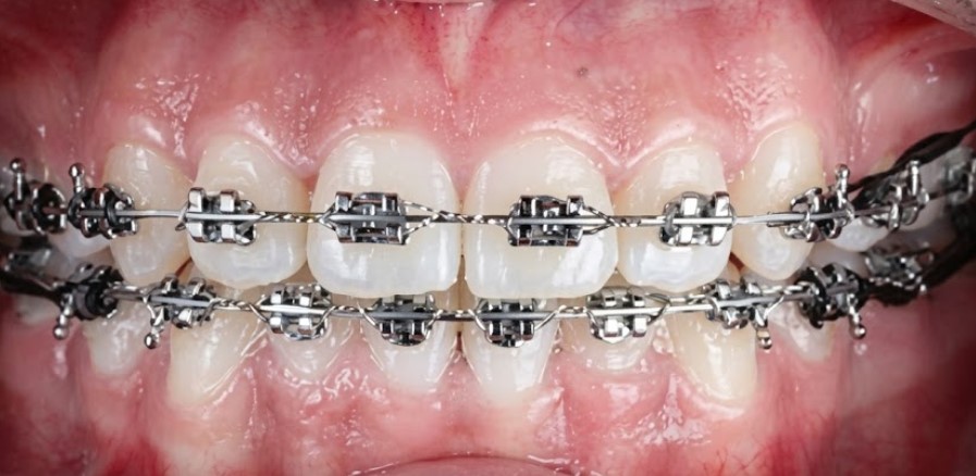 Before treatment